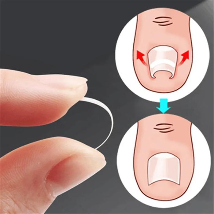 10pcs Ingrown Toenail Correction Clips