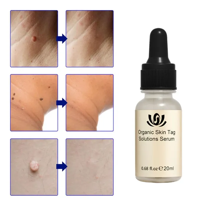 All-Natural Skin Tag and Mole Removal Serum, Herbal Formula