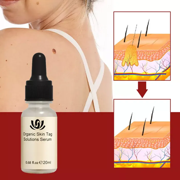 All-Natural Skin Tag and Mole Removal Serum, Herbal Formula