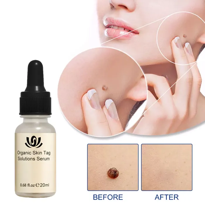 All-Natural Skin Tag and Mole Removal Serum, Herbal Formula