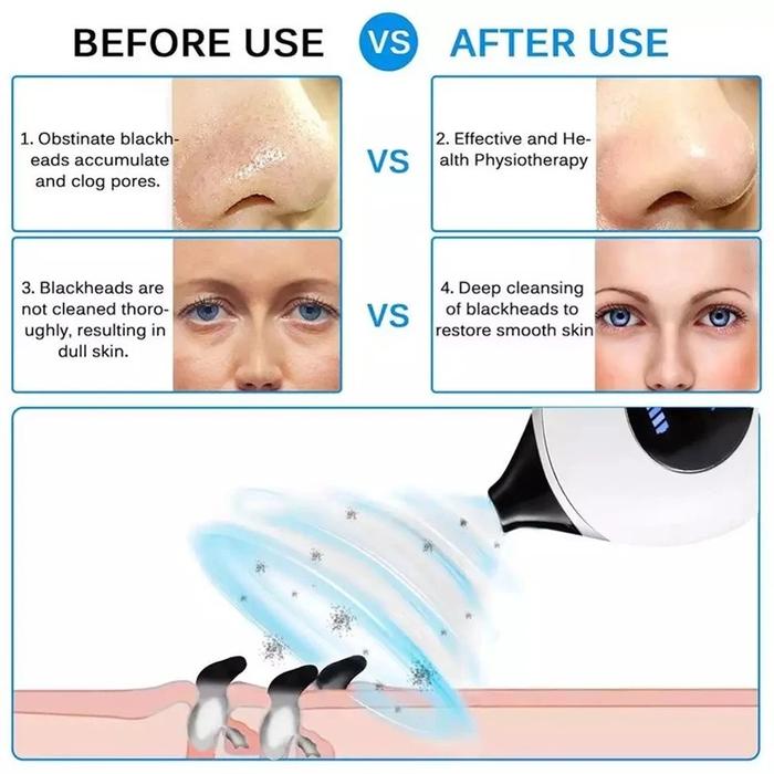 Electric Blackhead Remover Vacuum with 4 Suction Heads