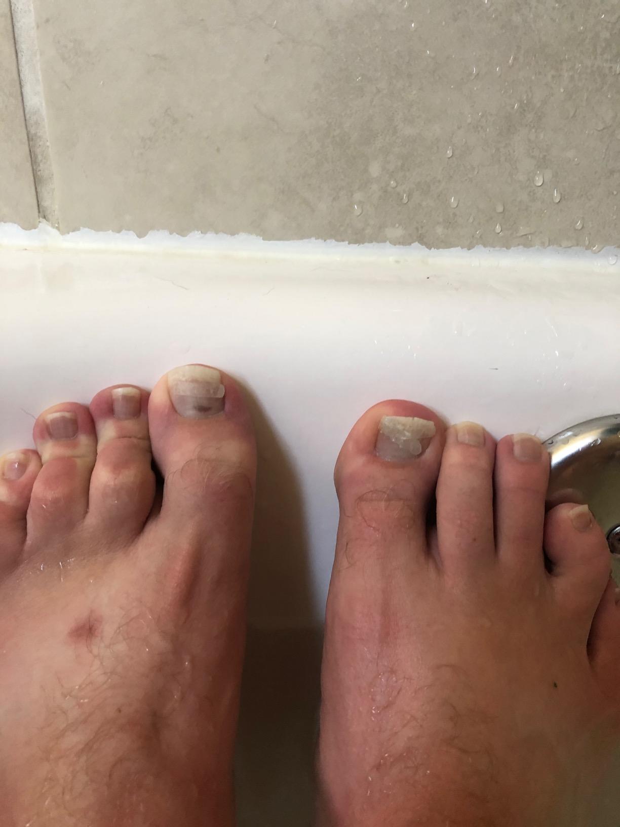 Ingrown Toe Nail Correction Sticker photo review