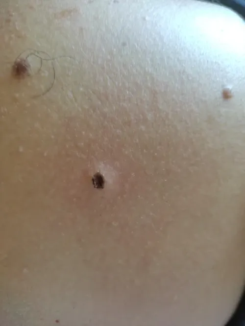 Plasma Pen To Remove Skin Tags, Moles And Warns photo review