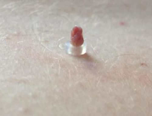 Skin Tag Removal Device, Meat Mole Removal, Corn Removal photo review