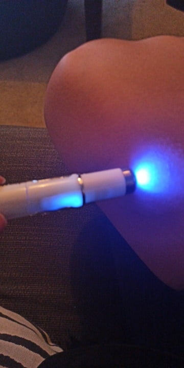 Acne Laser Pen Wrinkle, Soft Scars Removal Machine Portable Durable Blue Light photo review