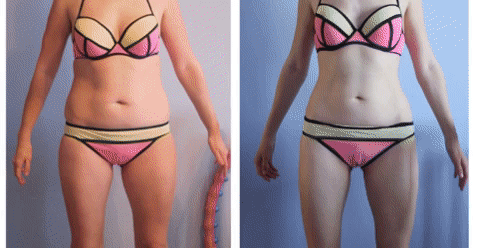Ultrasonic Fat Cavitation Machine before and after